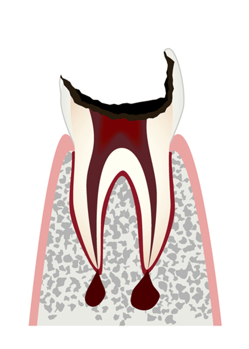 残根状態のむし歯